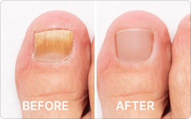 Close-up customer use progression style image for Blinzador
